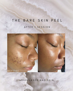 The Bare Skin Peel
