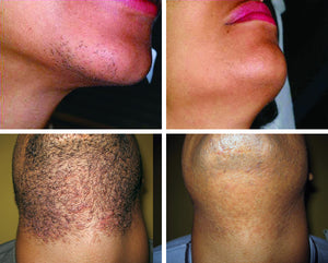 The GentleMax Pro® - Laser Hair Removal - Laser genesis - Pigmentation Removal