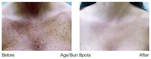 The GentleMax Pro® - Laser Hair Removal - Laser genesis - Pigmentation Removal