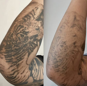 Tattoo Removal