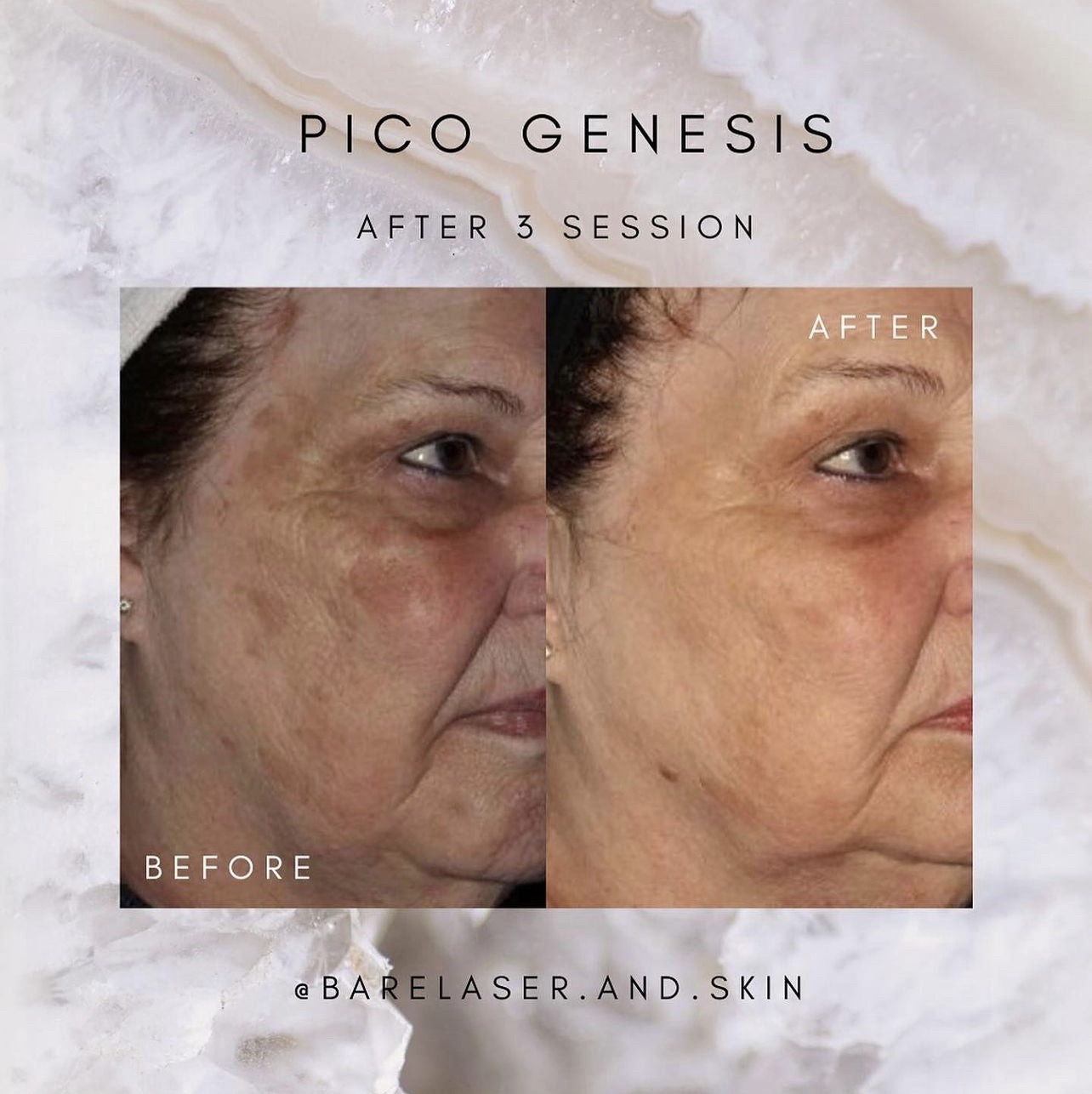 Pigmentation and Malasma removal with the Enlighten 3