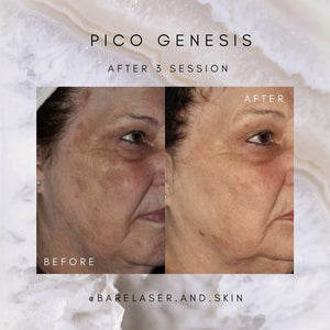 Pigmentation and Malasma removal with the Enlighten 3